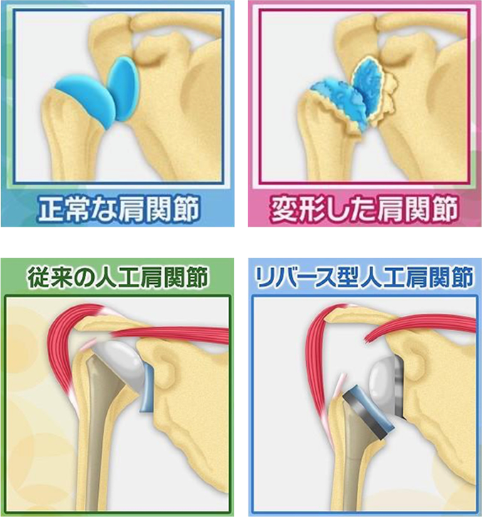 人工 関節 スポーツ 医学 センター